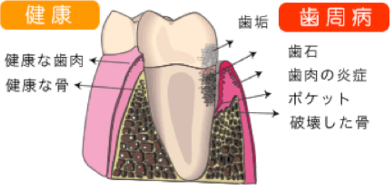 歯周病とは